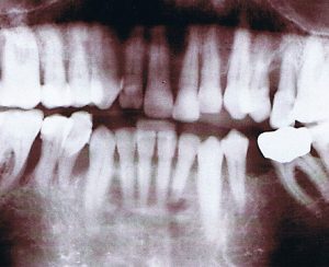 Implantate bei Patienten mit aggressiver Parodontitis